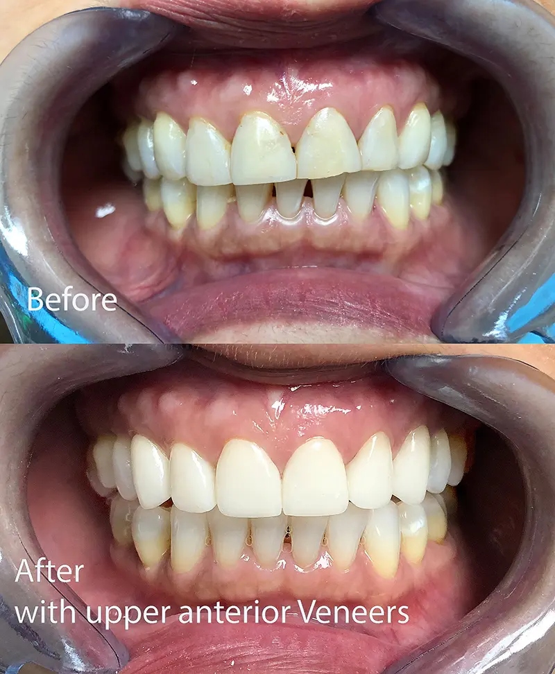 Cosmetic Veneers & Crowns 9